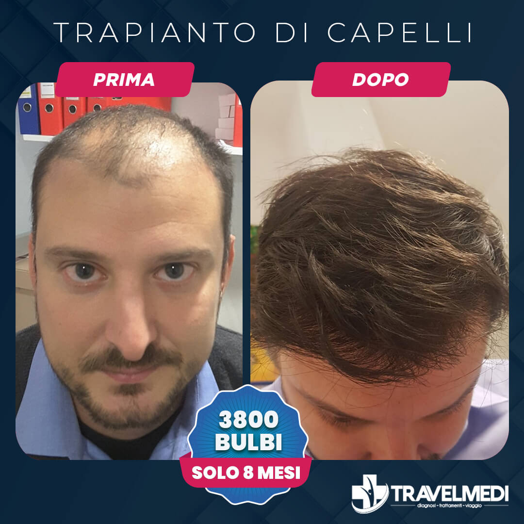 Hair Transplant before after in Turkey