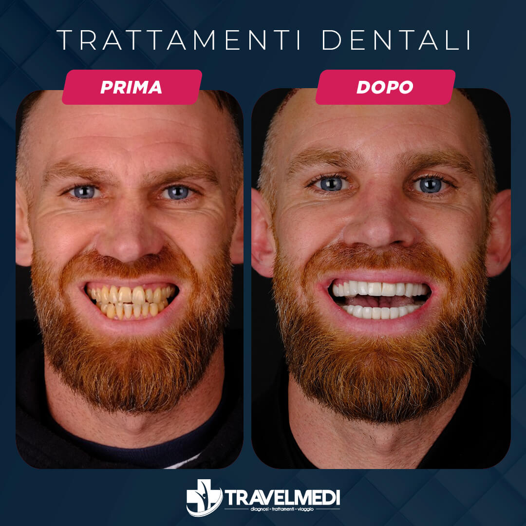 Trattamenti dentali prima dopo in Turchia